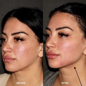 How long does it take for Juvederm to look good?
