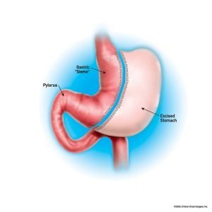How long gastric sleeve surgery takes time to heal?