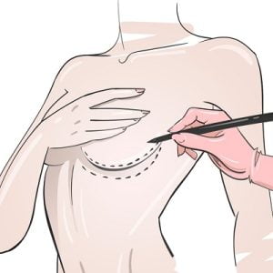 How much does a breast lift cost in Pakistan