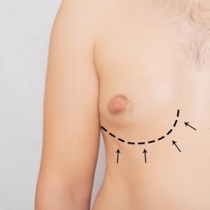 How much does gynecomastia surgery cost in Islamabad?