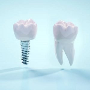 Is dental implant surgery worth the trouble?