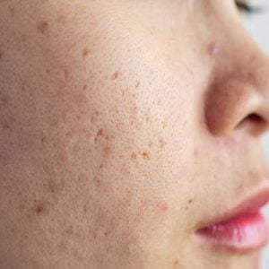 What is the typical duration for acne scars to fade?