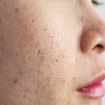What is the typical duration for acne scars to fade