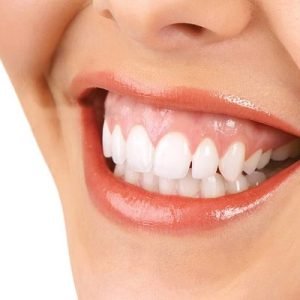What is the typical duration required to correct a gummy smile?