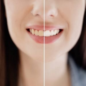 Why are my teeth yellow?