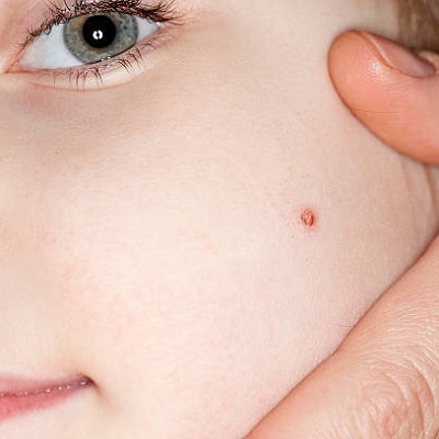 Why warts be formed on our skin?