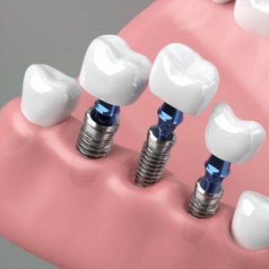 Would smoking affect my dental implants?