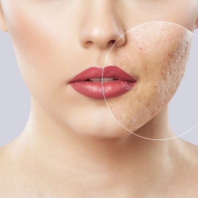 Which type of acne scar presents the most challenging treatment?