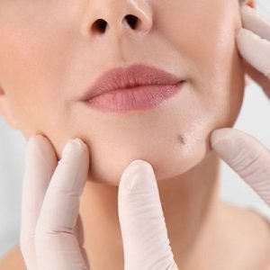 Can mole removal leave scars?