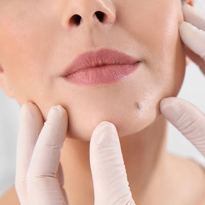 can mole removal leave scars?