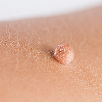 Are there any drawbacks of skin tag removal treatment?