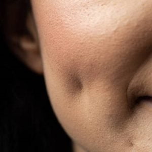 Can dimples be artificially created?