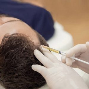 Does hair filler for baldness work?