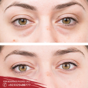 Exploring The Benefits Of Eye Bag Removal In Islamabad