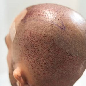 Get successful hair transplant with maximum density