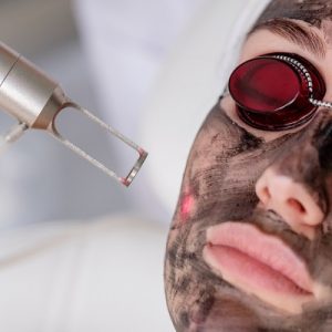How long do the laser carbon peel results last?