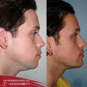 How long does a cheek implant last?