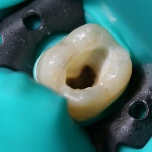 How many years does a root canal last?
