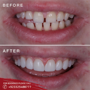 Tooth bonding cost in Islamabad