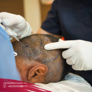 Is Fue hair transplant a better option?