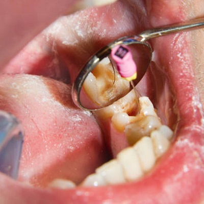 8 Interesting Facts About The Root Canal In Islamabad? | Root canal