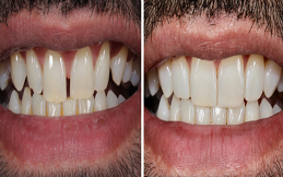 Tooth bonding cost in Islamabad