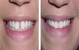 Tooth bonding in Islamabad