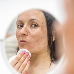 Top 4 Melasma Treatment Options in Islamabad