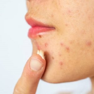 Unlocking the Secrets of Acne-Free Beauty