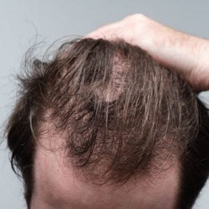 What are the Top 4 Reasons for Hair Loss?