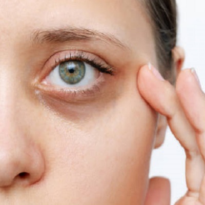 What is the best treatment for eye bags in Pakistan? |Eye Bag Removal