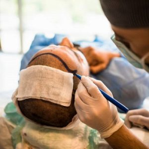 5 Benefits of Hair Transplant in Islamabad