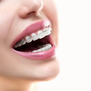 Can i get braces with dental implants?