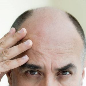 Hair transplant offer long-term,natural-looking hair?
