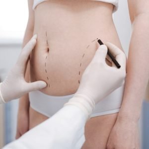 Does liposuction give permanent results?