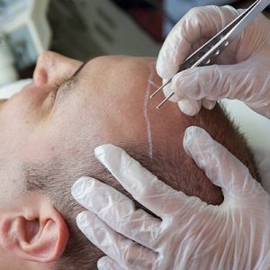 How Can FUE Hair Transplant Transform Your Appearance?