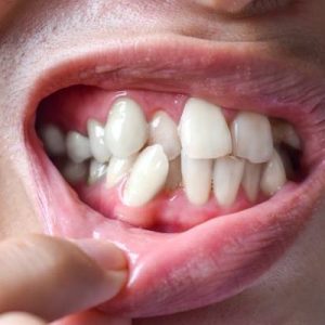 How do dentists fix overlapping teeth?
