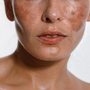 How to cure melasma from the inside?