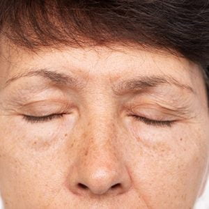 How to set loose skin of eyelids without surgery?