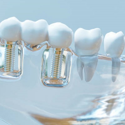 Is a dental implant difficult to clean or not