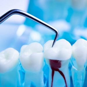 Is it possible for a root canal to become infected?