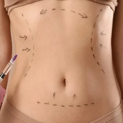 Liposuction For Men | Male Fat Removal Surgery in Islamabad