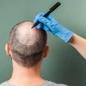 The Risks of choosing a cheap Hair Transplant