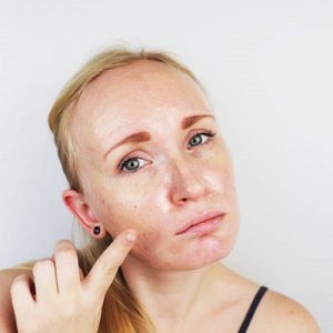 Top 3 best treatments for pigmentation on face in Pakistan?