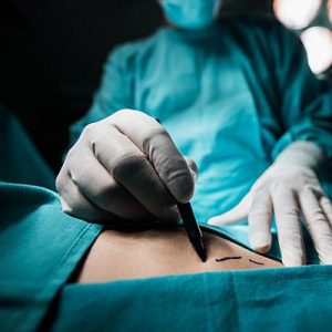 Top 3 liposuction areas for women