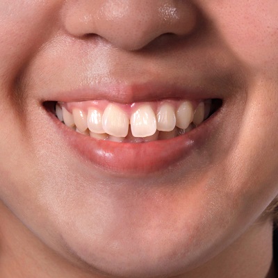 What are protruding teeth and how can a dentist fix them