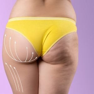 What is cellulite and how can I get rid of it permanently?