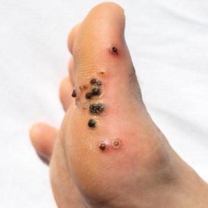 What is the best warts removal method?