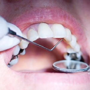 What is the safest method of dental filling?