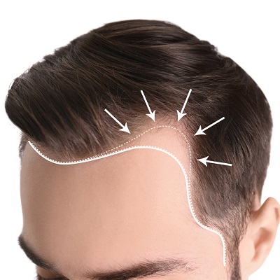 Which signs tell that you are ready for a hair transplant?